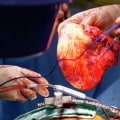 Heart Transplantation in Central Texas: What You Need to Know