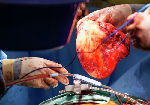 Heart Transplantation in Central Texas: What You Need to Know